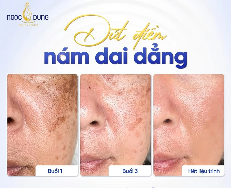 Top 6 địa chỉ trị nám tại Vinh uy tín, hiệu quả cao, có bảo hành